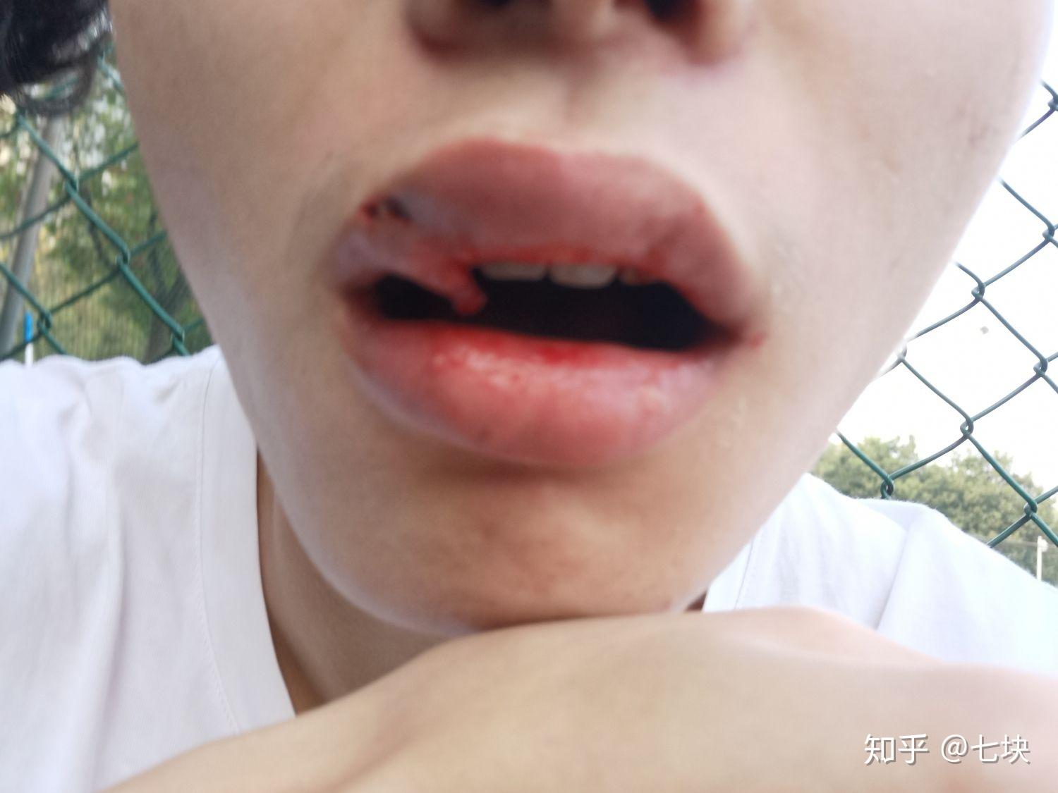打篮球伤到嘴怎么办? - 知乎