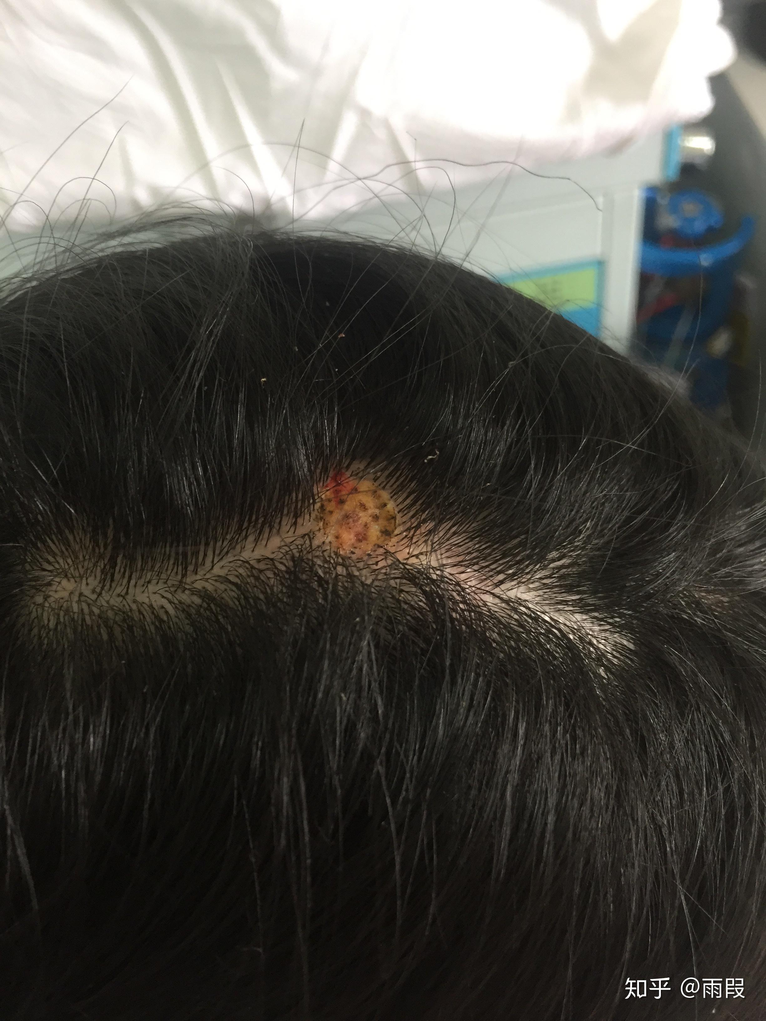 头上有颗肉痣