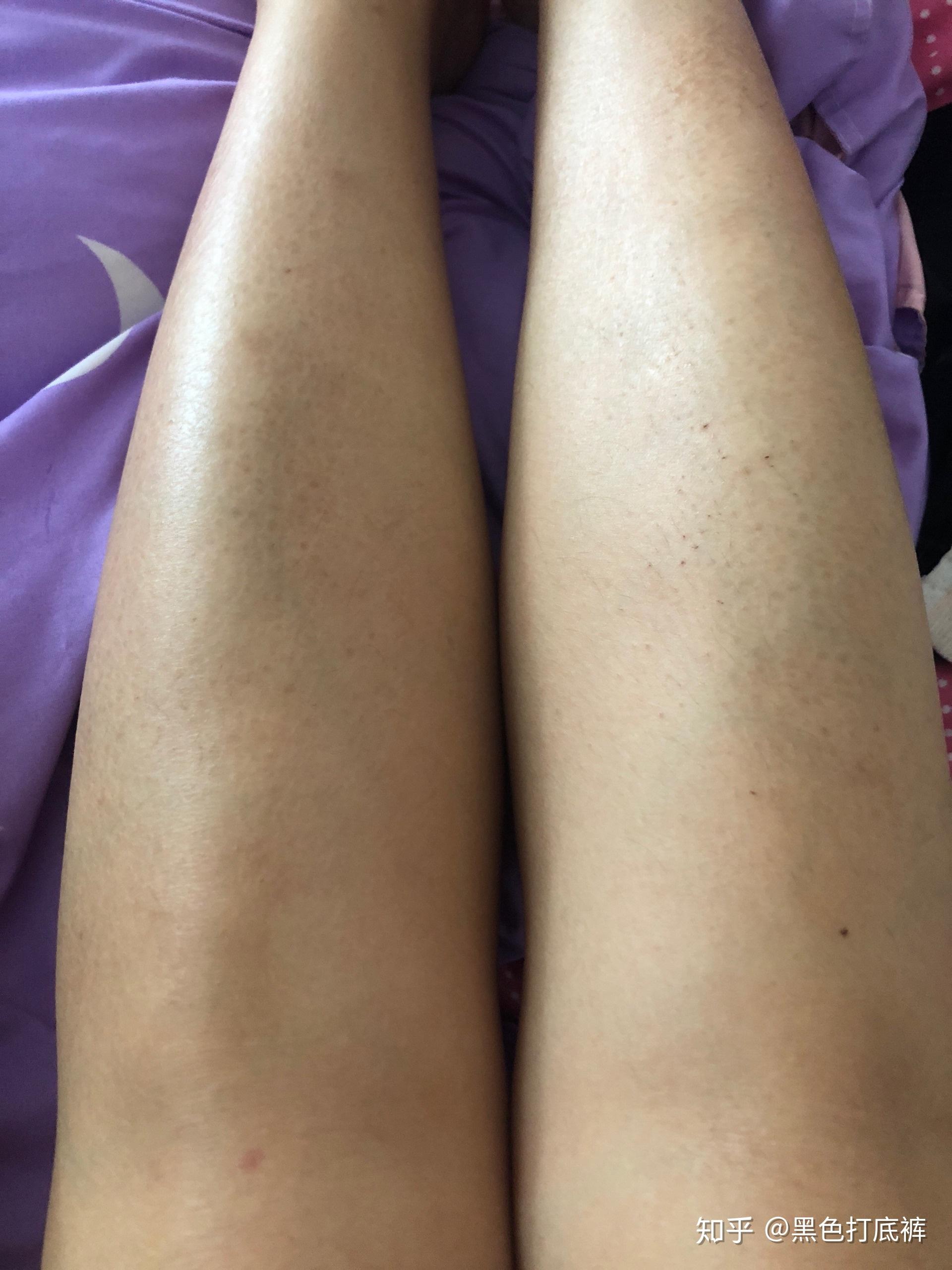 身上长有鱼鳞病就是常说的蛇皮怎么办夏天小腿皮肤看着那样的裂纹很丑