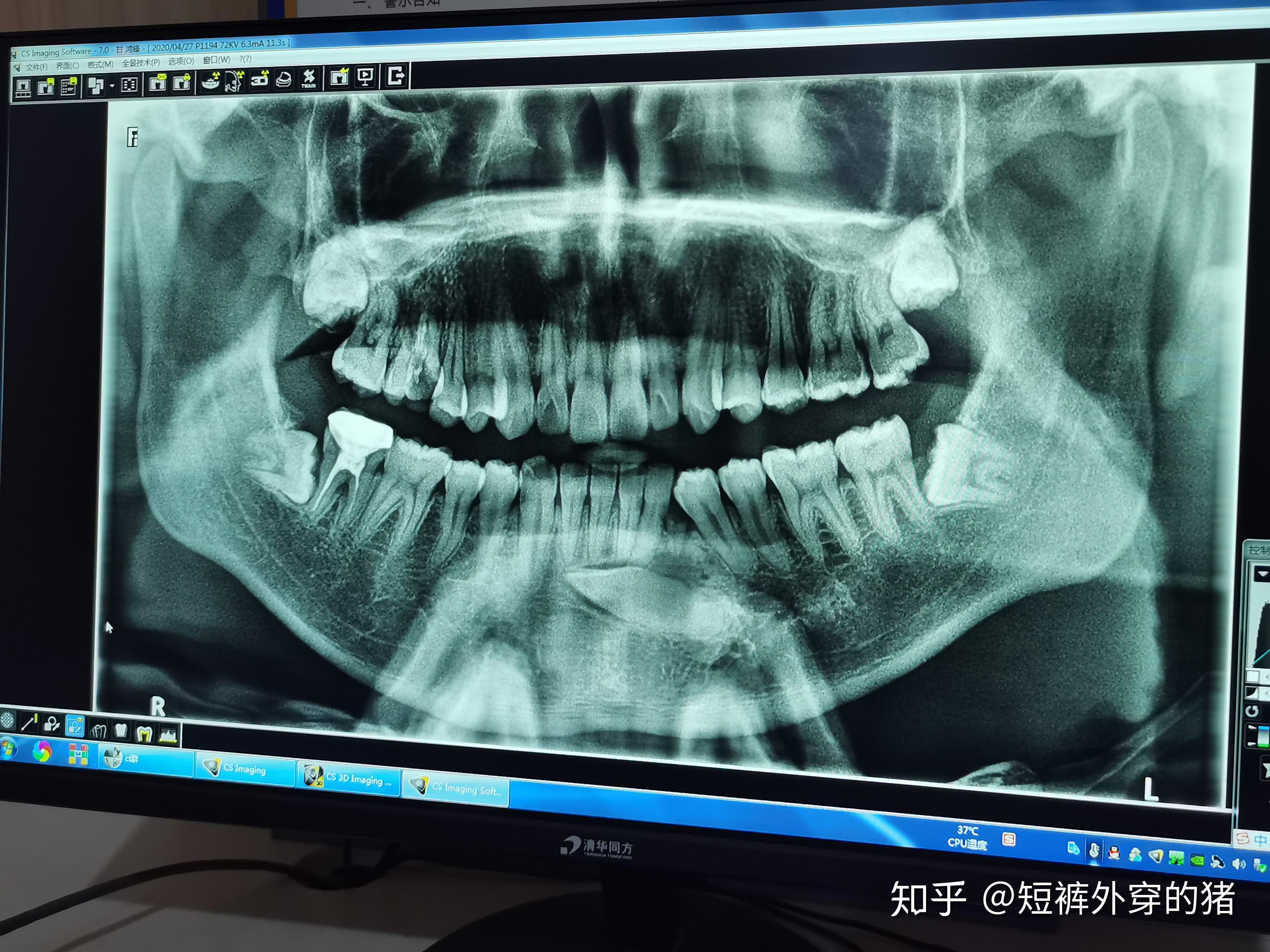 靠近下颌骨的位置有颗埋伏牙请问应该怎么治疗