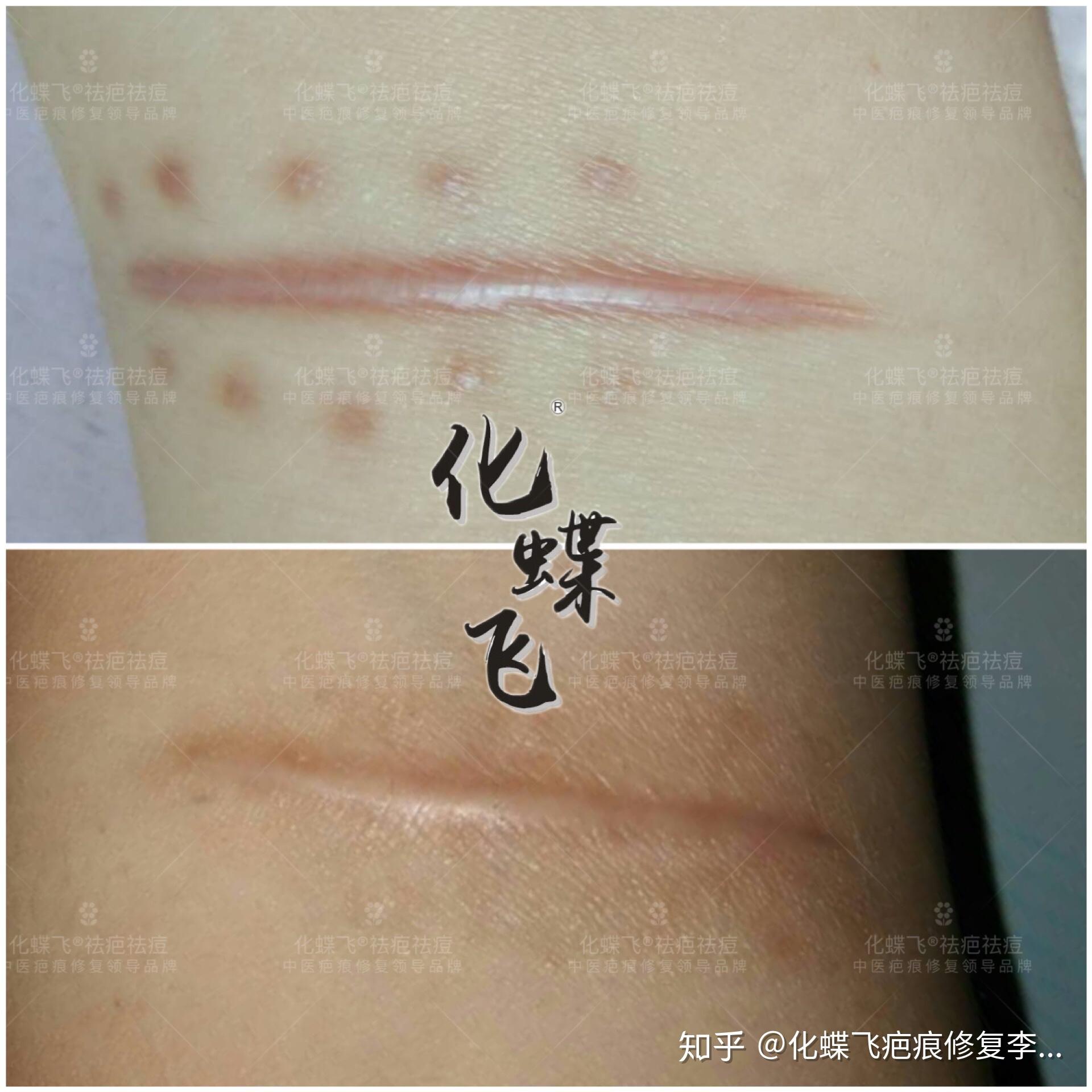 刀伤缝合拆线后增生了怎么办? - 知乎