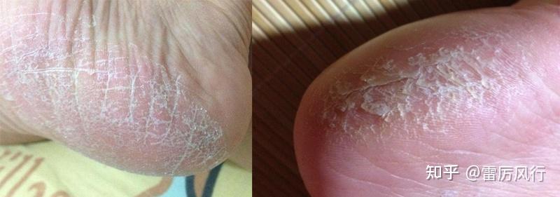 脱屑型脚癣病症有哪些