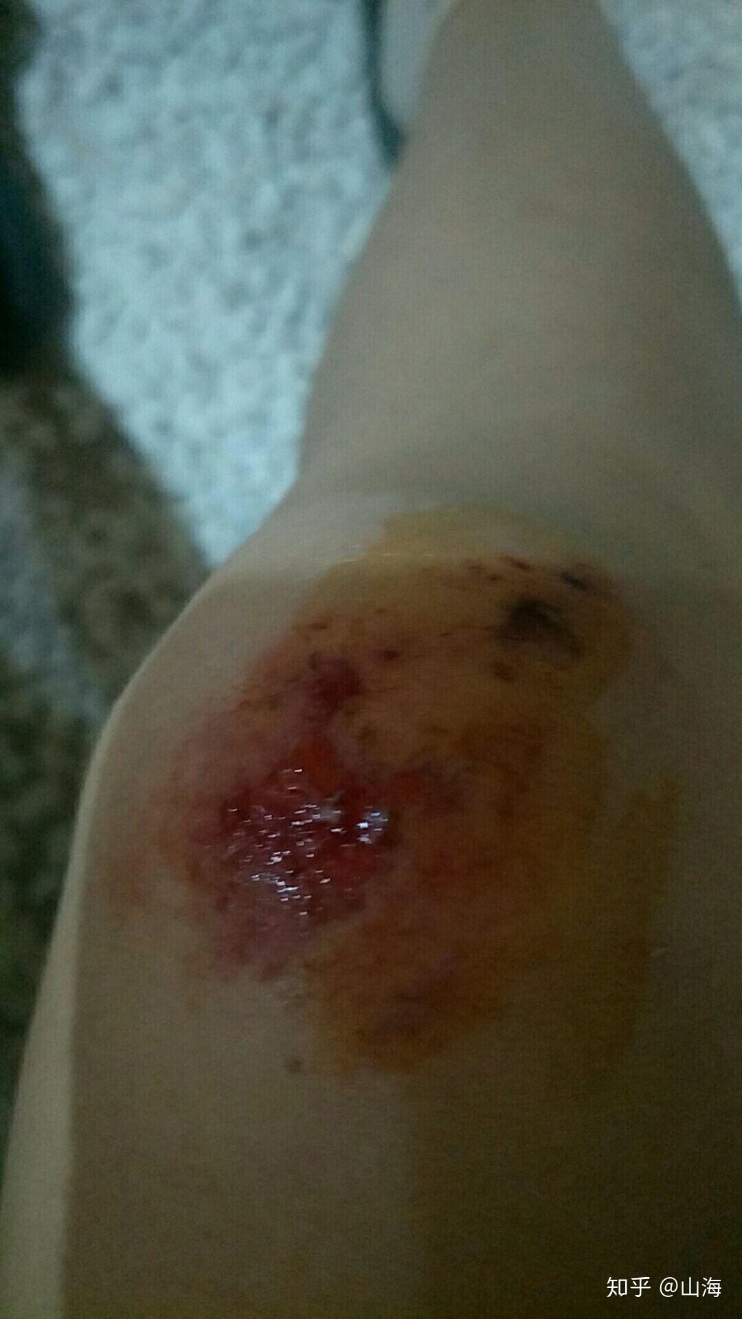 女生骑车摔倒擦伤图片图片