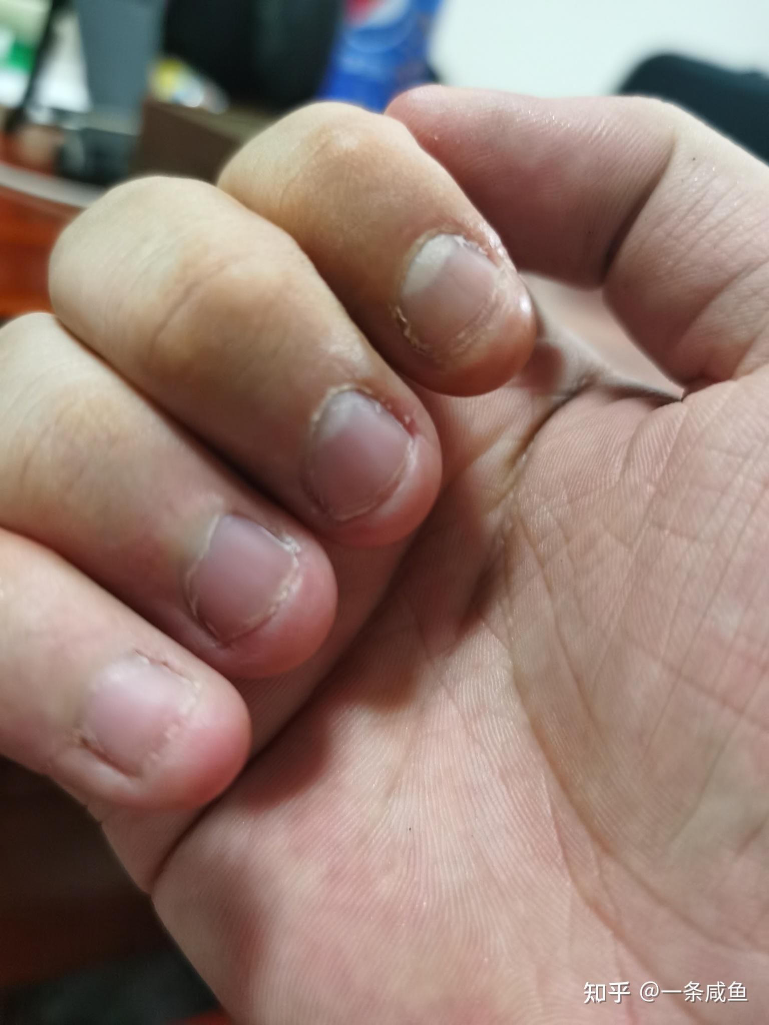 导致了手指很丑!还变形了,有什么办法可以让手变得好看一点?