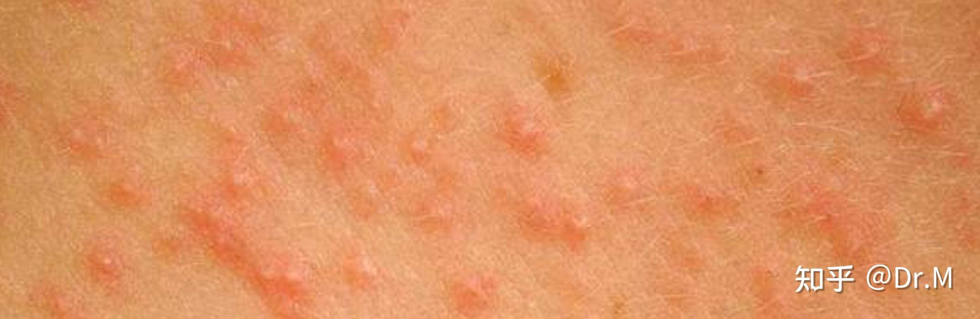 HIV急性期症状——皮疹 - 知乎