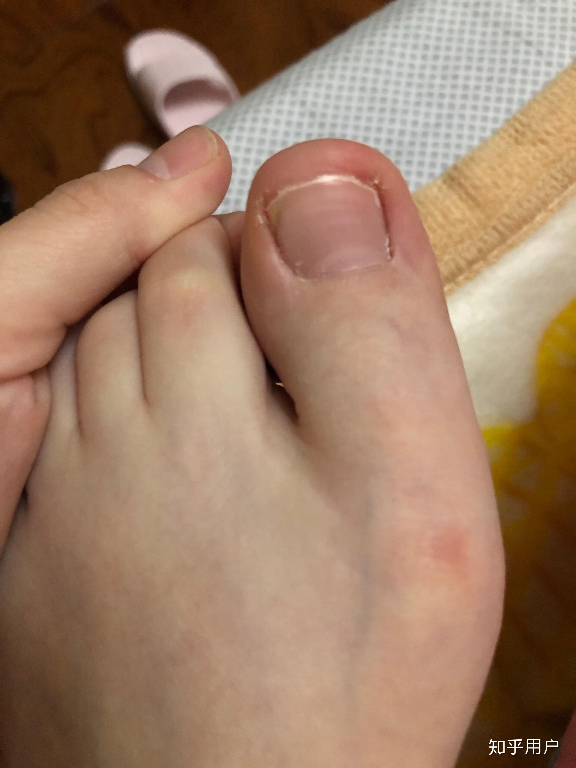 大脚趾甲沟炎不剪能长好吗