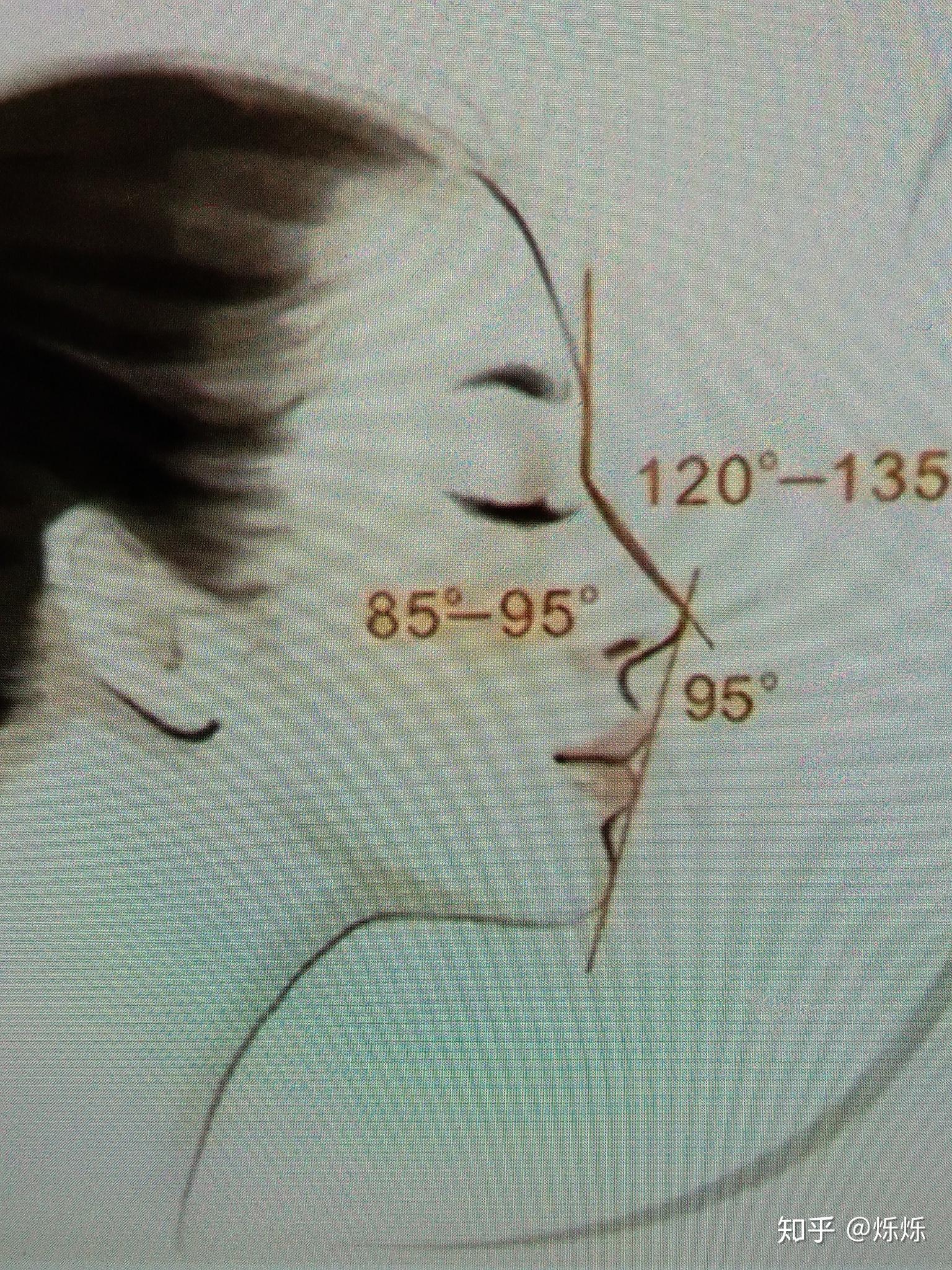 鼻梁高低和鼻基底凹陷怎么区分这样算鼻基底凹陷吗