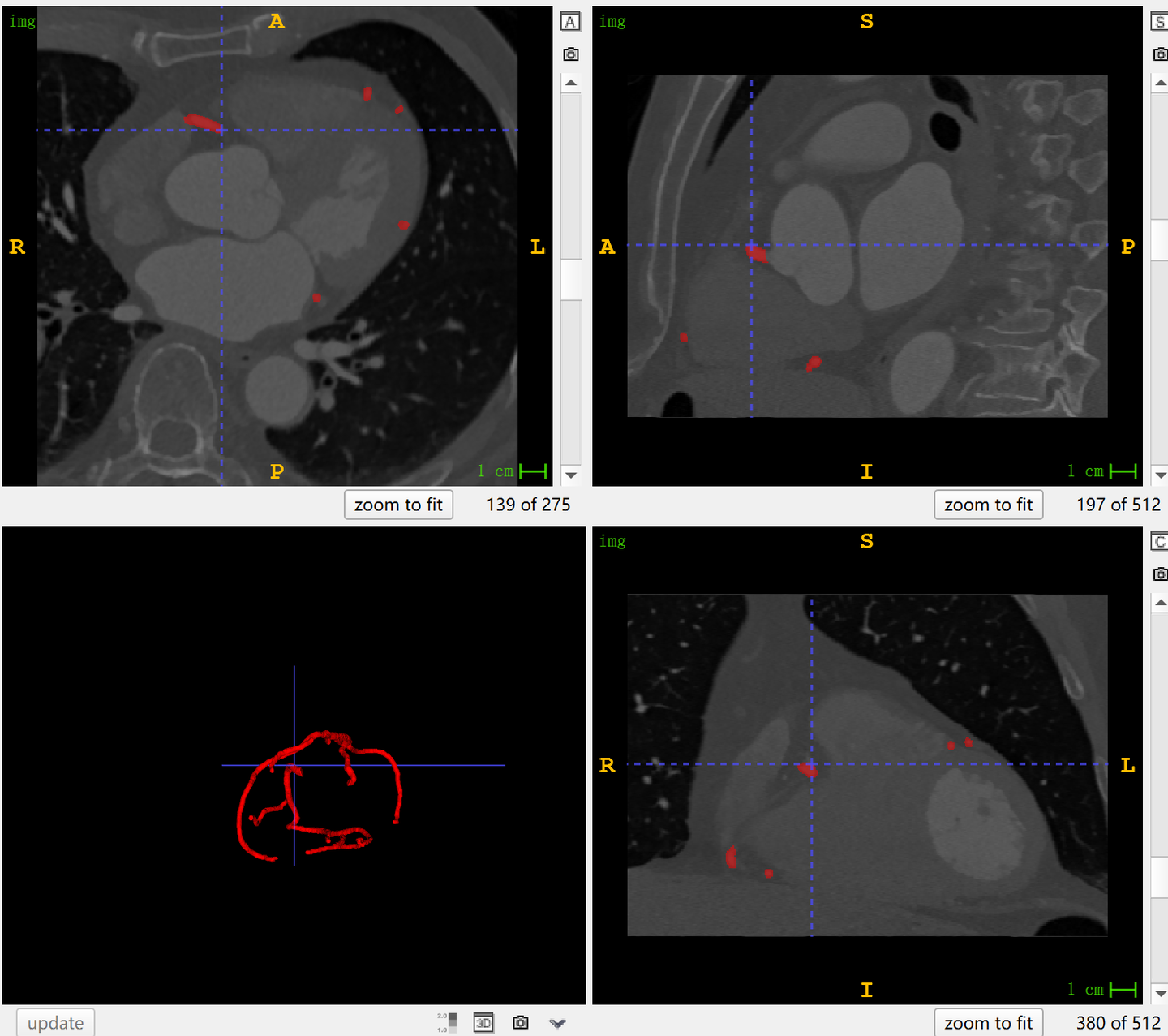 ImageCAS 大规模 CT 血管造影图像冠状动脉分割数据集介绍 - 知乎