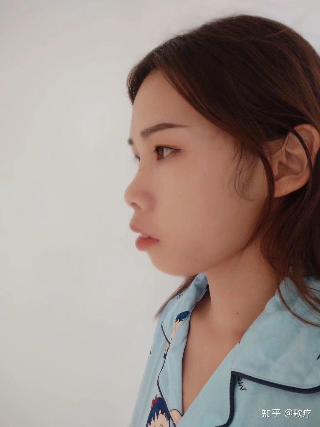 龅牙凸嘴怎么改善侧脸? - 知乎