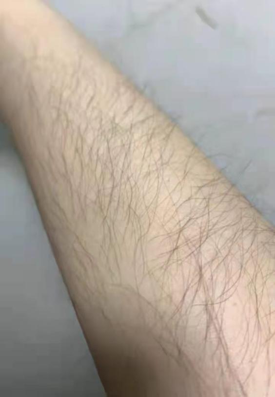 女生可是手臂上汗毛长又多,夏天怎么办好?