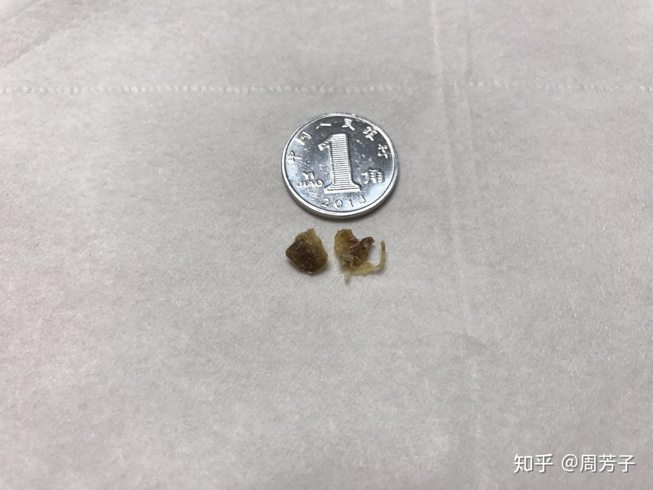 3岁女宝耳朵的耳屎堵住怎样清理
