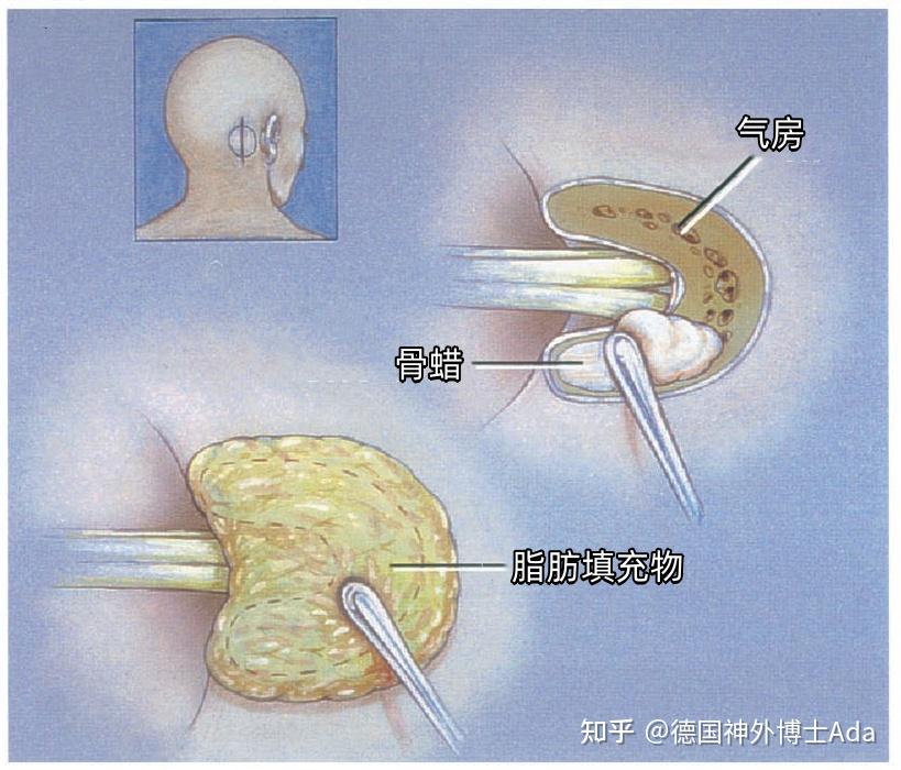 听神经瘤解剖---Rhoton解剖文献学习笔记系列 - 知乎
