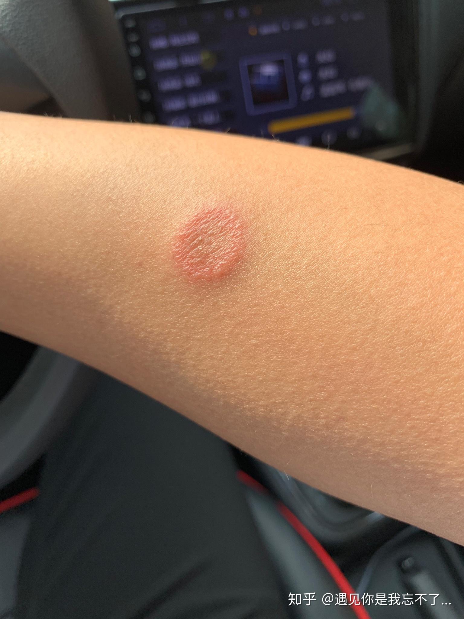 人得了猫癣发痒怎么办? - 知乎