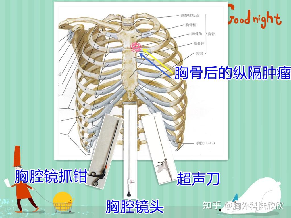 胸腔镜手术有什么优点? - 知乎