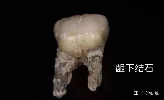 龈下刮治本身是否会增加之后龈下结石的可能(有片)? - 知乎