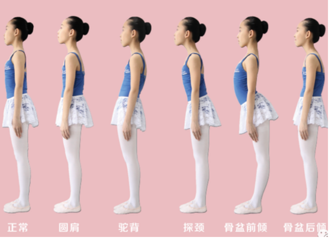头前伸、腰前突、屁股“翘”——孩子可能骨盆前倾了！ - 知乎