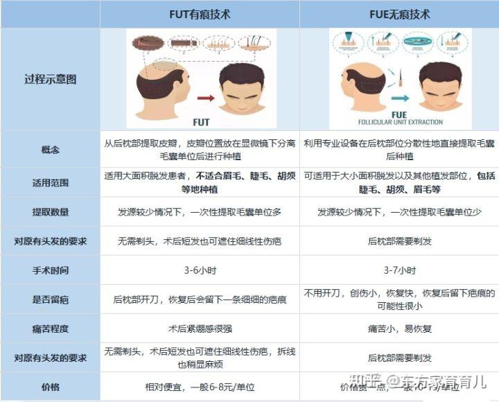 无痕植发技术