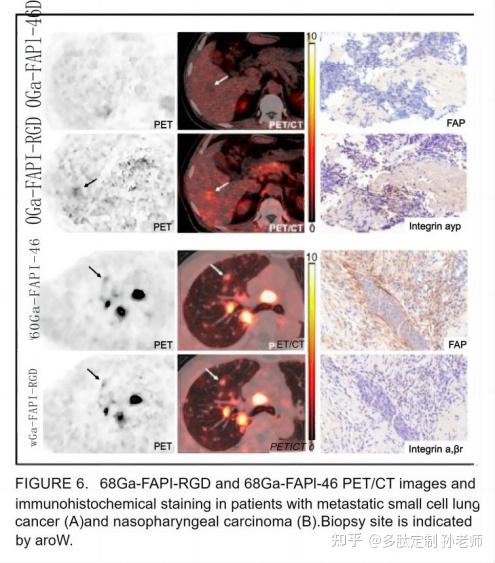 文献分享：68Ga-FAPI-RGD显像成纤维细胞活化蛋白FAP和整合素avb3对不同癌症类型中的临床评价 - 知乎