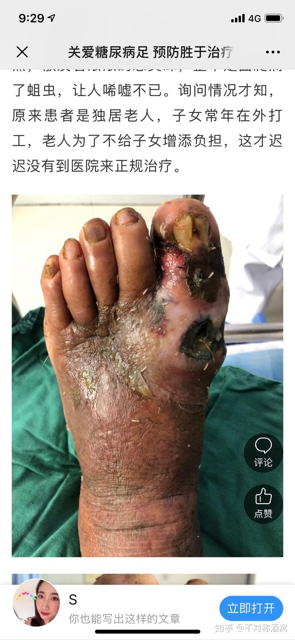 如果苍蝇在人的伤口产卵,会在身体里长成蛆吗? - 知乎