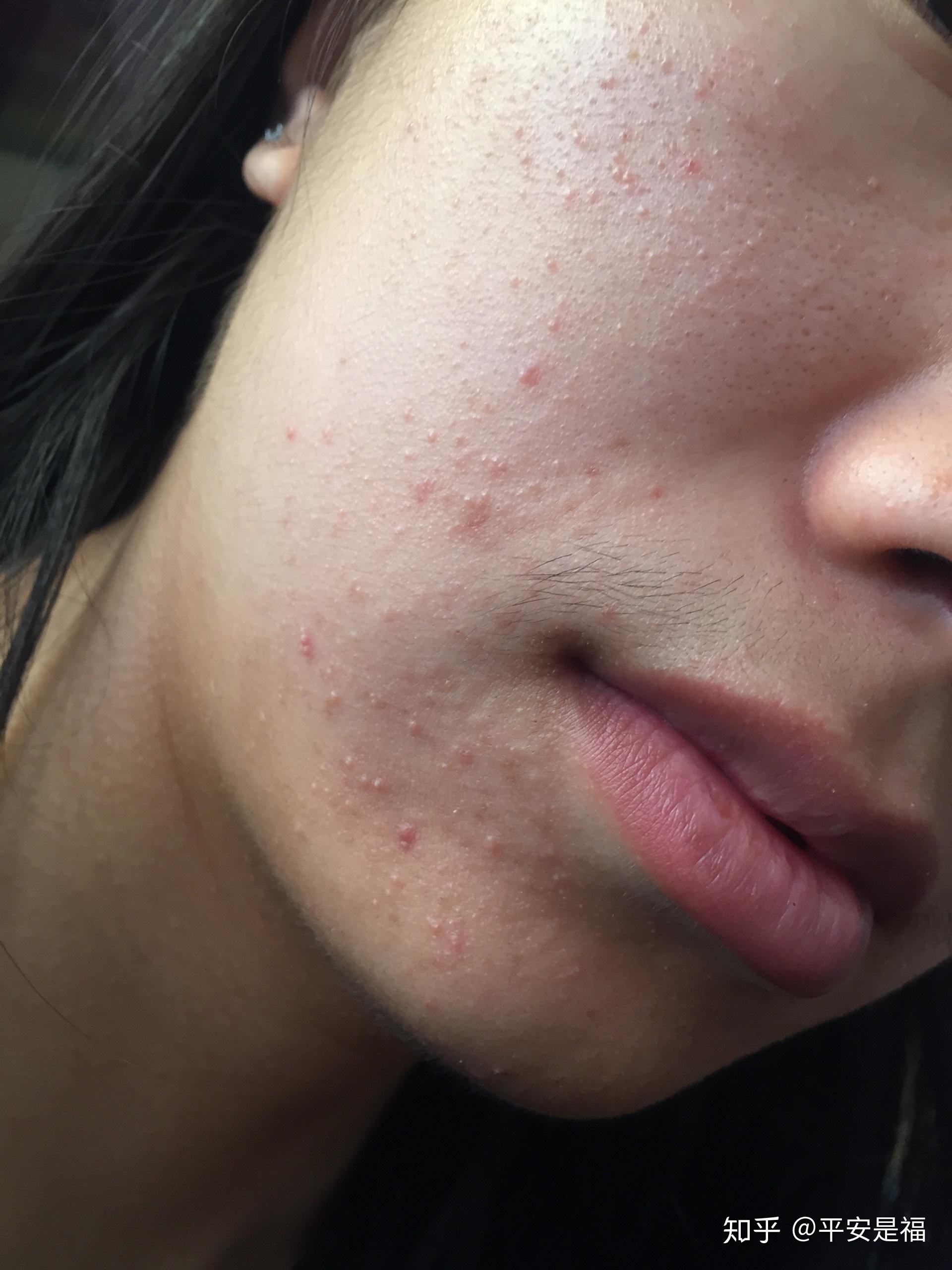 脂溢性皮炎有治好的朋友吗给点信心吧