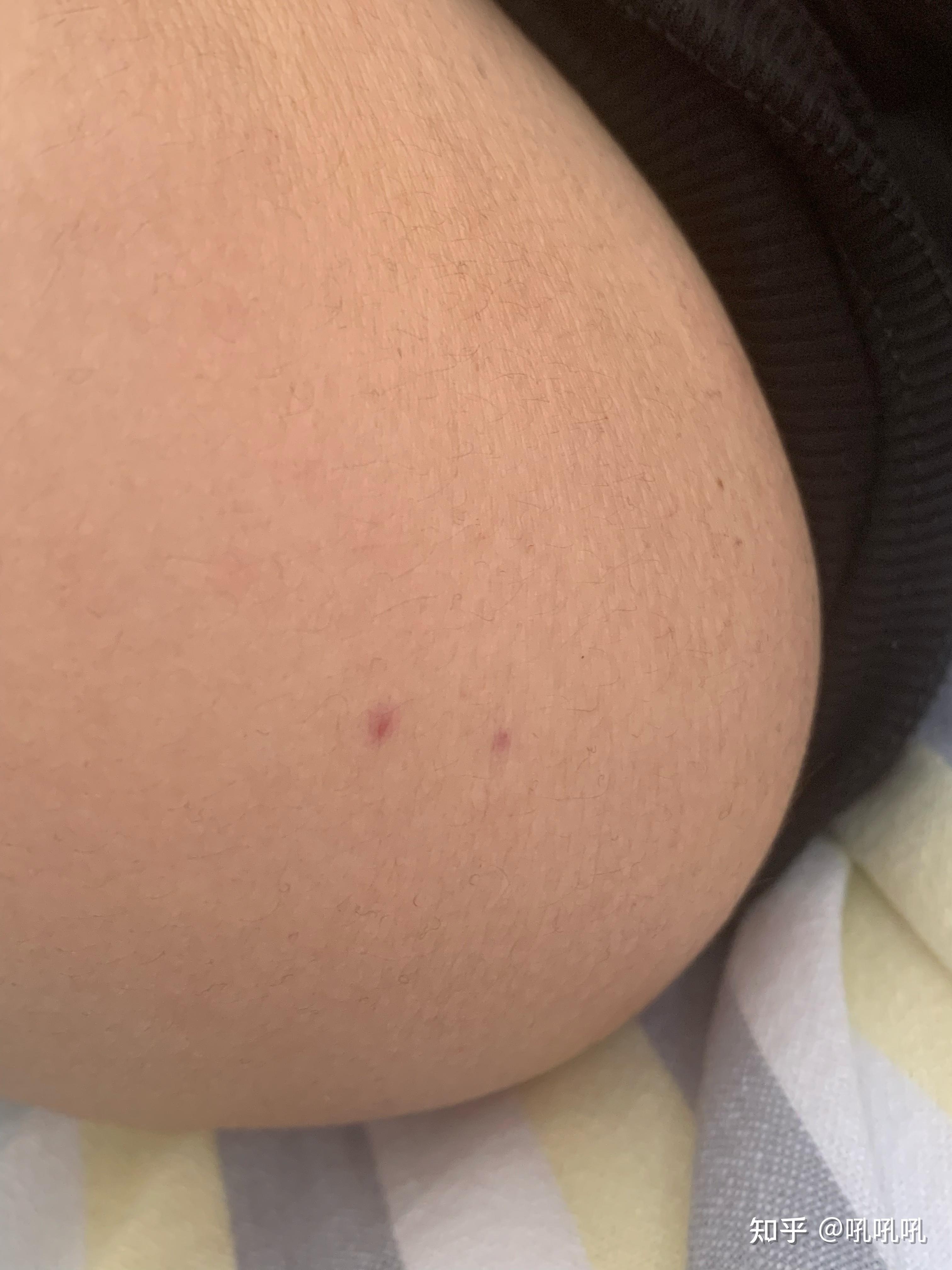 什么虫咬人是两个针眼大小的点?