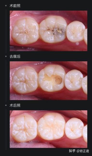 补牙的价格是多少?补牙材料有什么区别吗?医院医生怎么选择呢? - 知乎