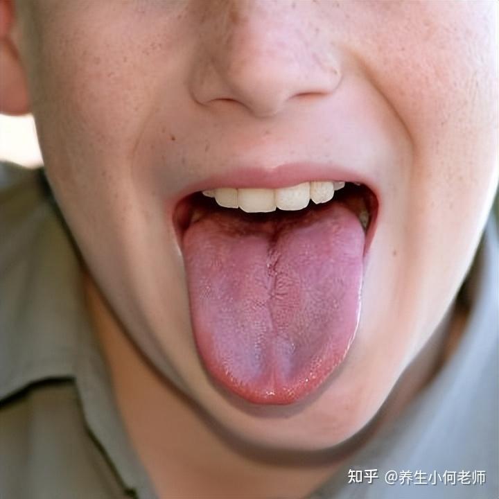 舌头中间有裂纹,是身体哪里出现了问题? - 知乎