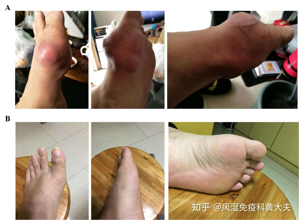 痛风石溶解会痛吗