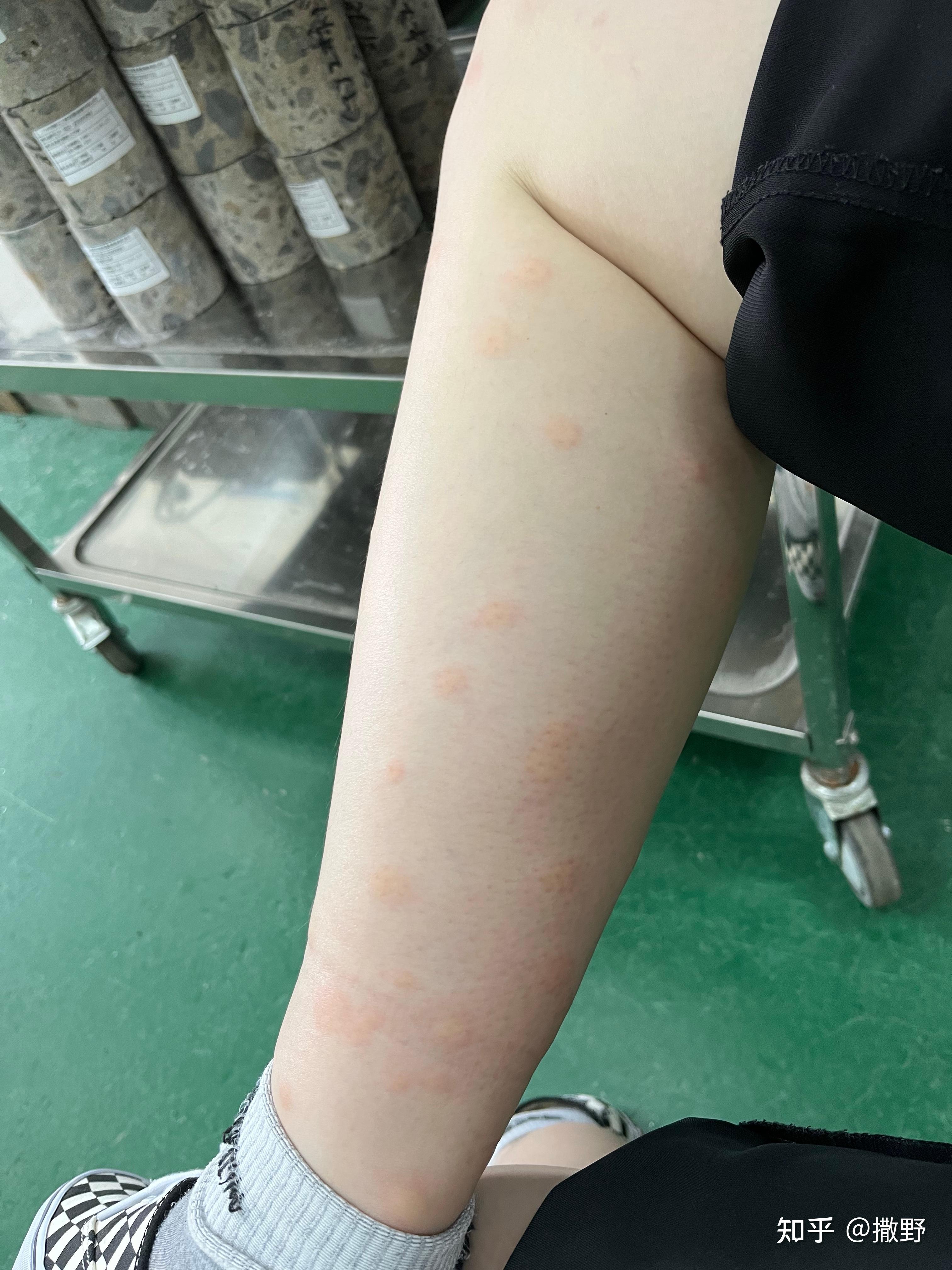 蠓一种很难发现的小黑蚊被折磨了好多年了昨天出门