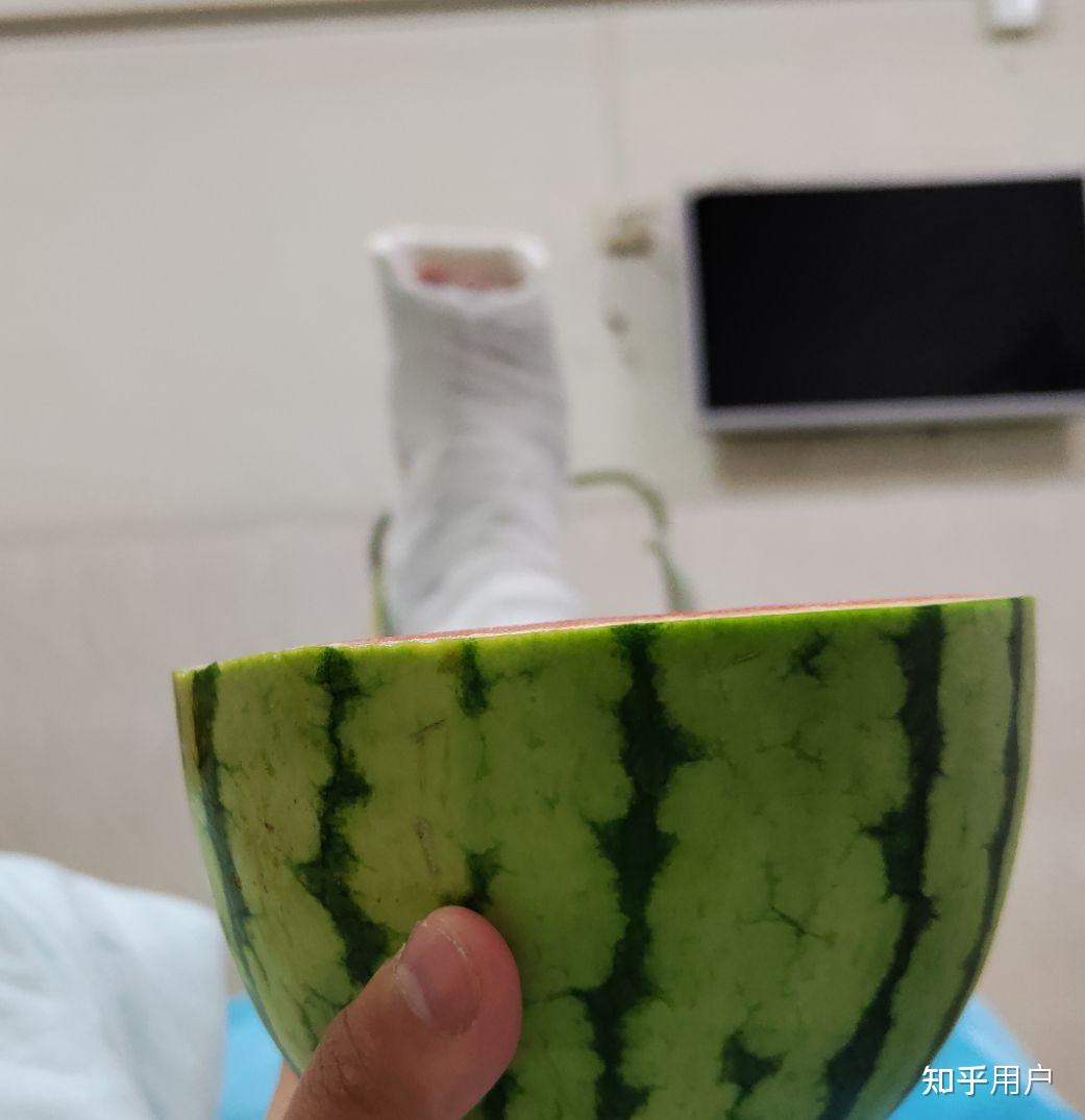 小脚趾头骨折二十多天还要不要打石膏?