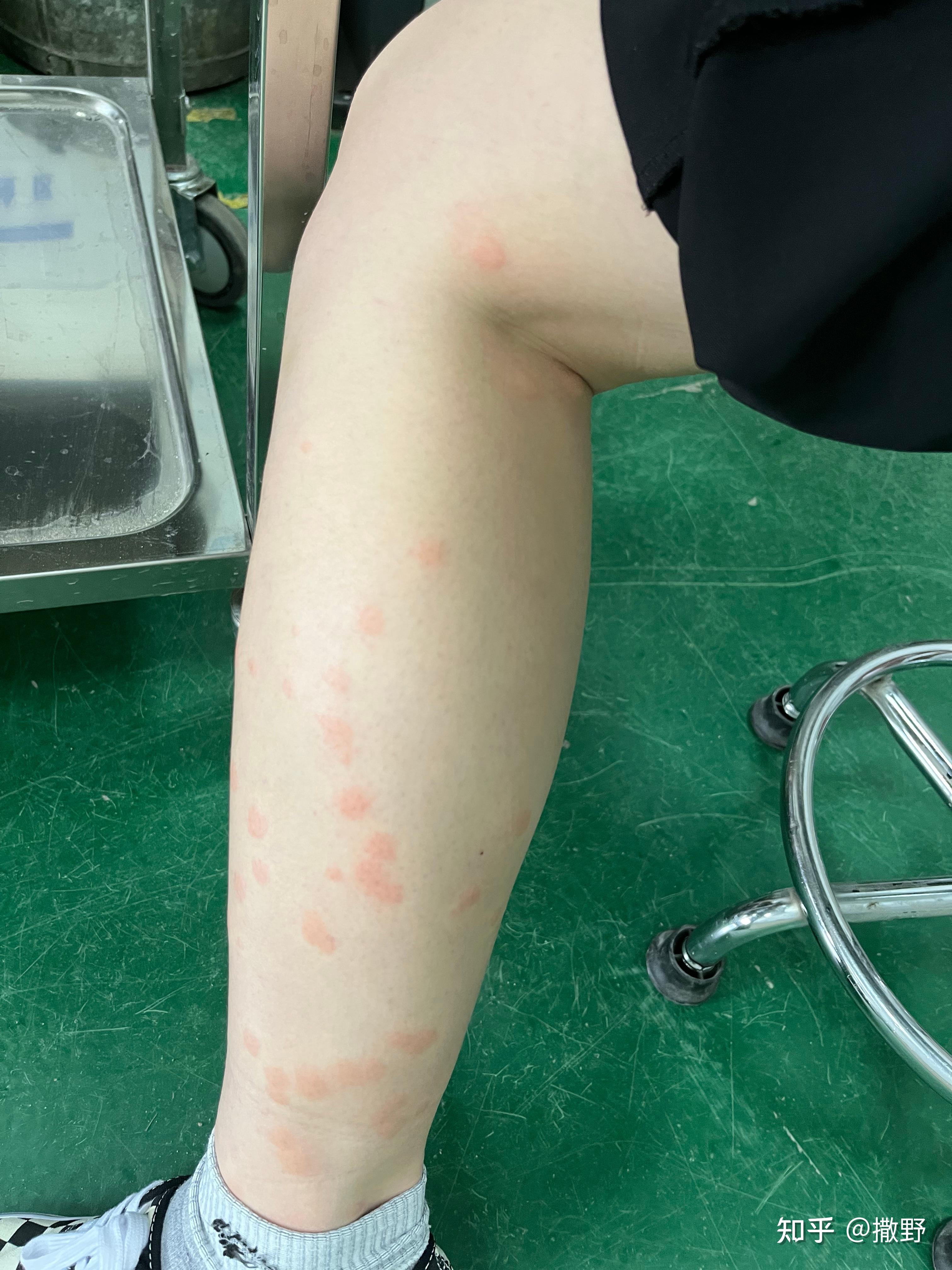 蠓一种很难发现的小黑蚊被折磨了好多年了昨天出门