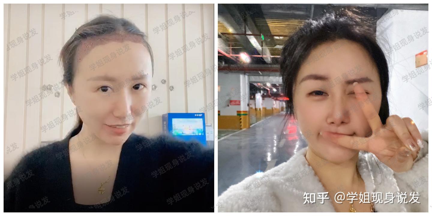 植发必看】别再被植发机构割韭菜了，原来真有人几大万花出去泡都不冒一个！分享我的植发亲身经历，关于植发的常见骗局、植发医院、植发医生... - 知乎