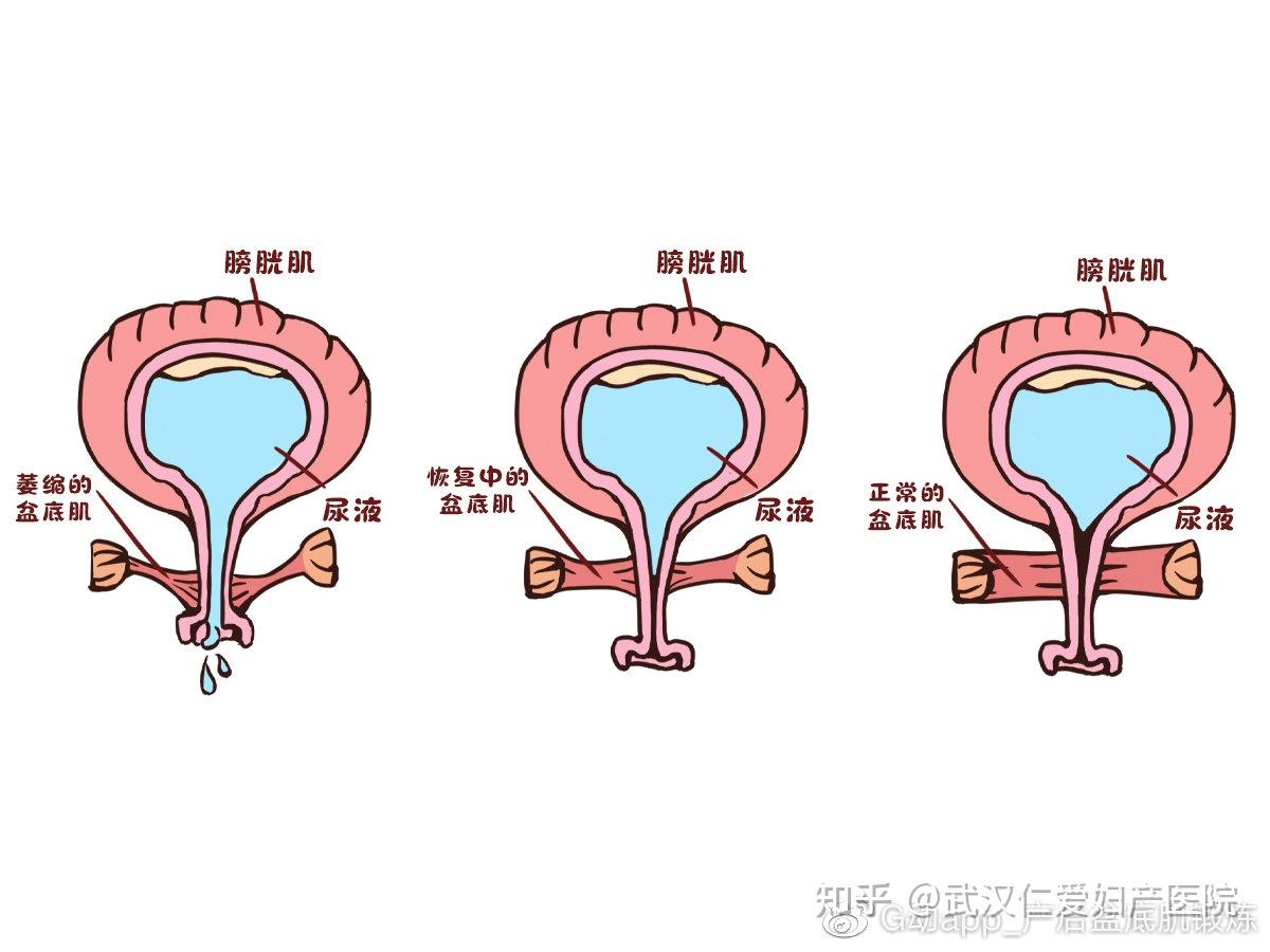 产后漏尿要怎么及时恢复