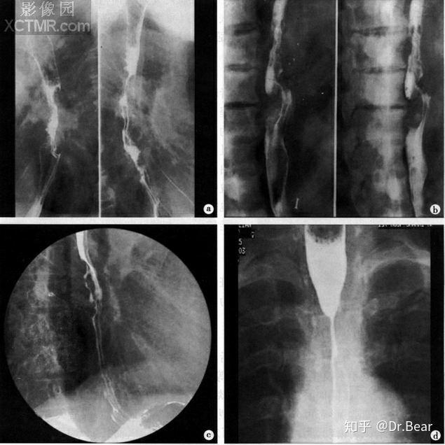 食管癌(esophageal carcinoma)影像学诊断 - 知乎