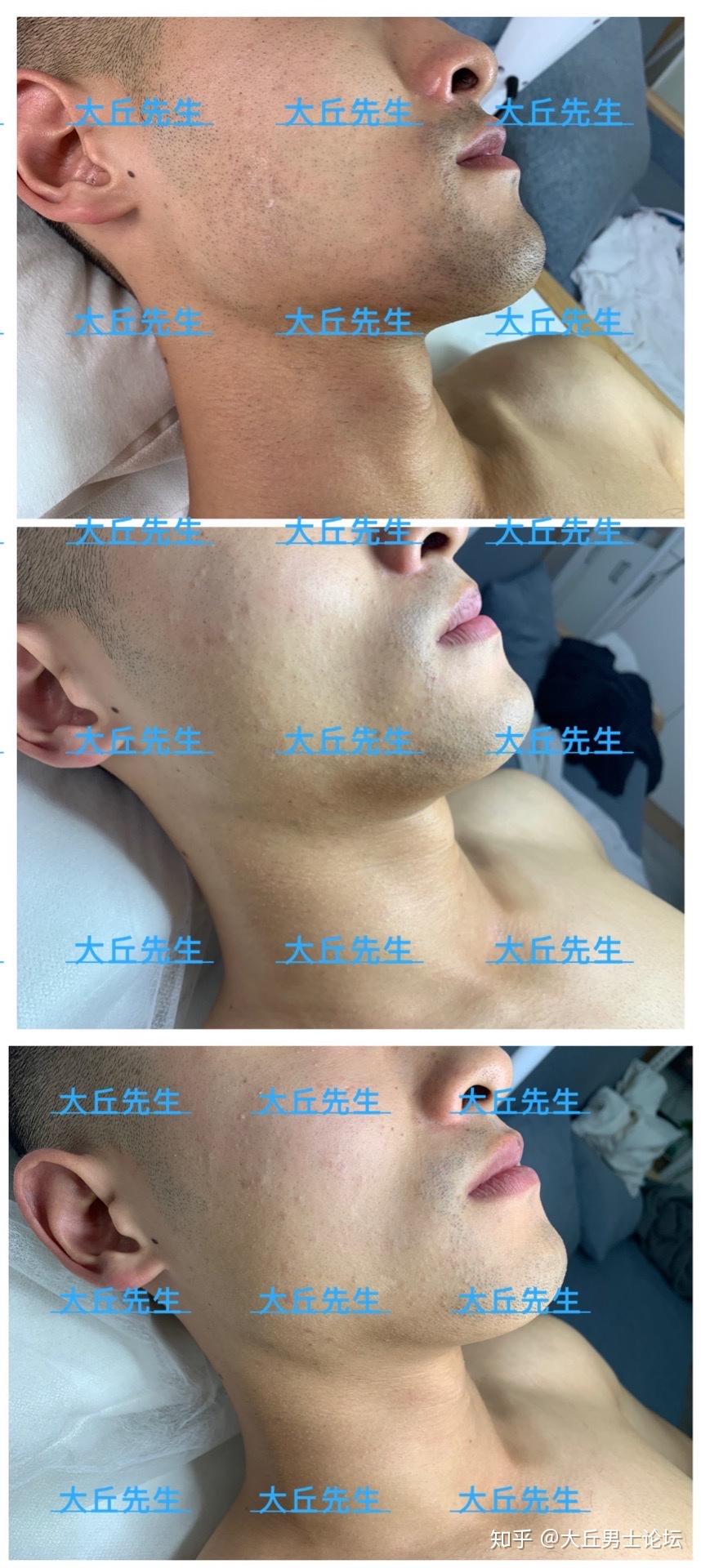 男士脸部胡须激光脱毛效果如何