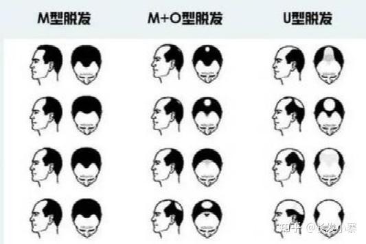 长发小寨-3大秃发警告信号! - 知乎