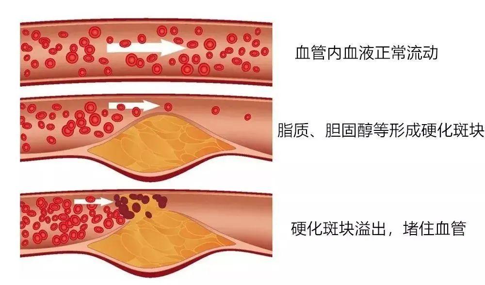 关于高血脂，看完这一篇就够了！纯干货 - 知乎