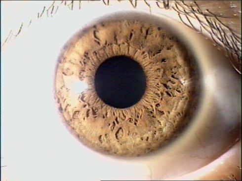 见光会眯成一条缝,如果睁开眼,眼睛会特别酸甚至流泪?