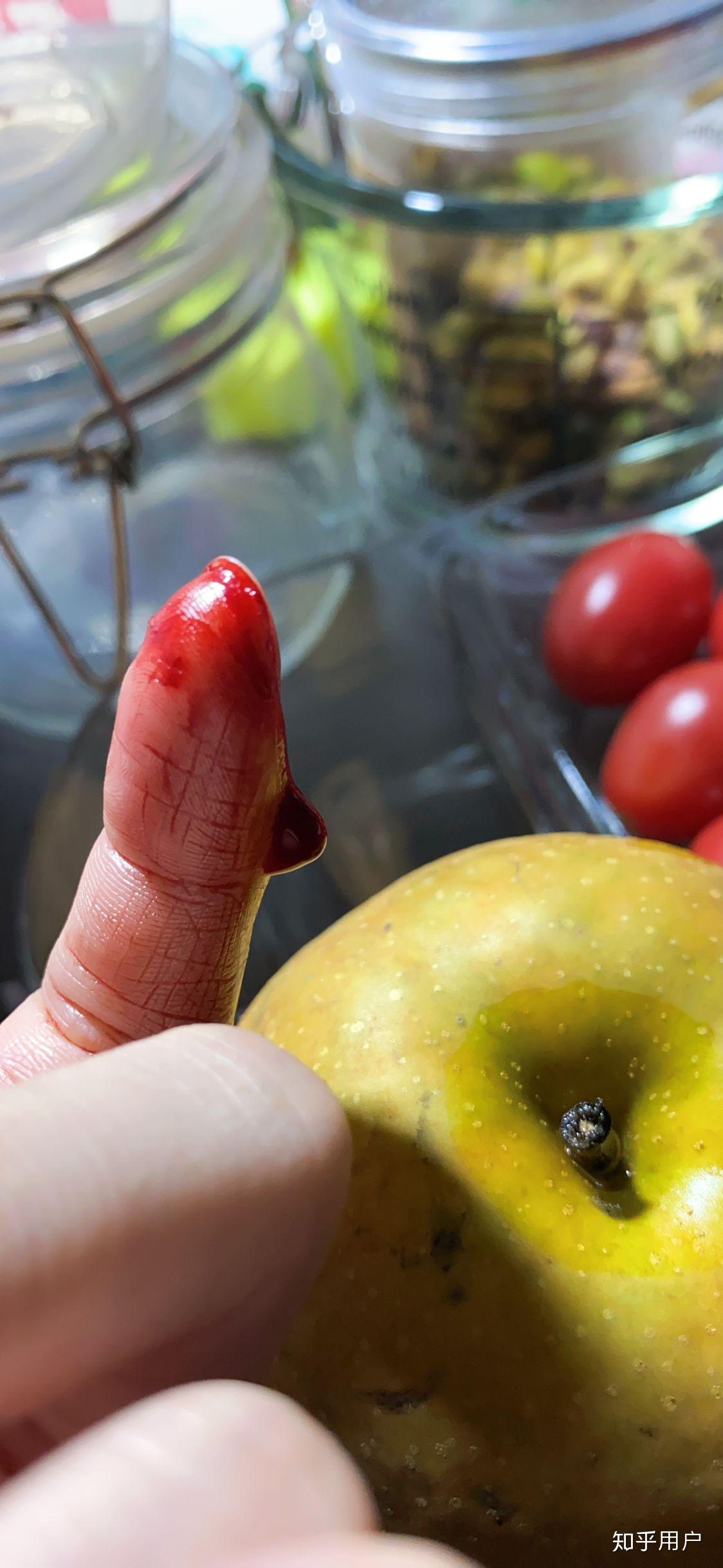 切菜切到手该怎么办