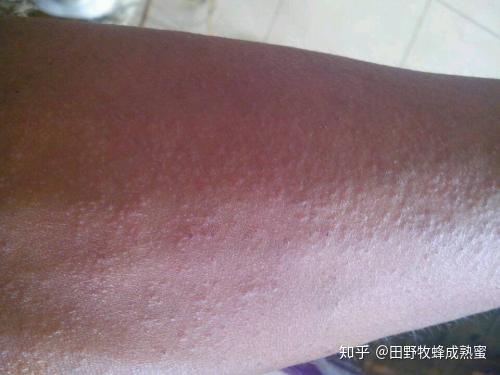 蜂蜜和什么过敏症状有关系(蜂蜜和什么过敏症状有关系呢) 蜂蜜和什么过敏症状有关系(蜂蜜和什么过敏症状有关系呢)