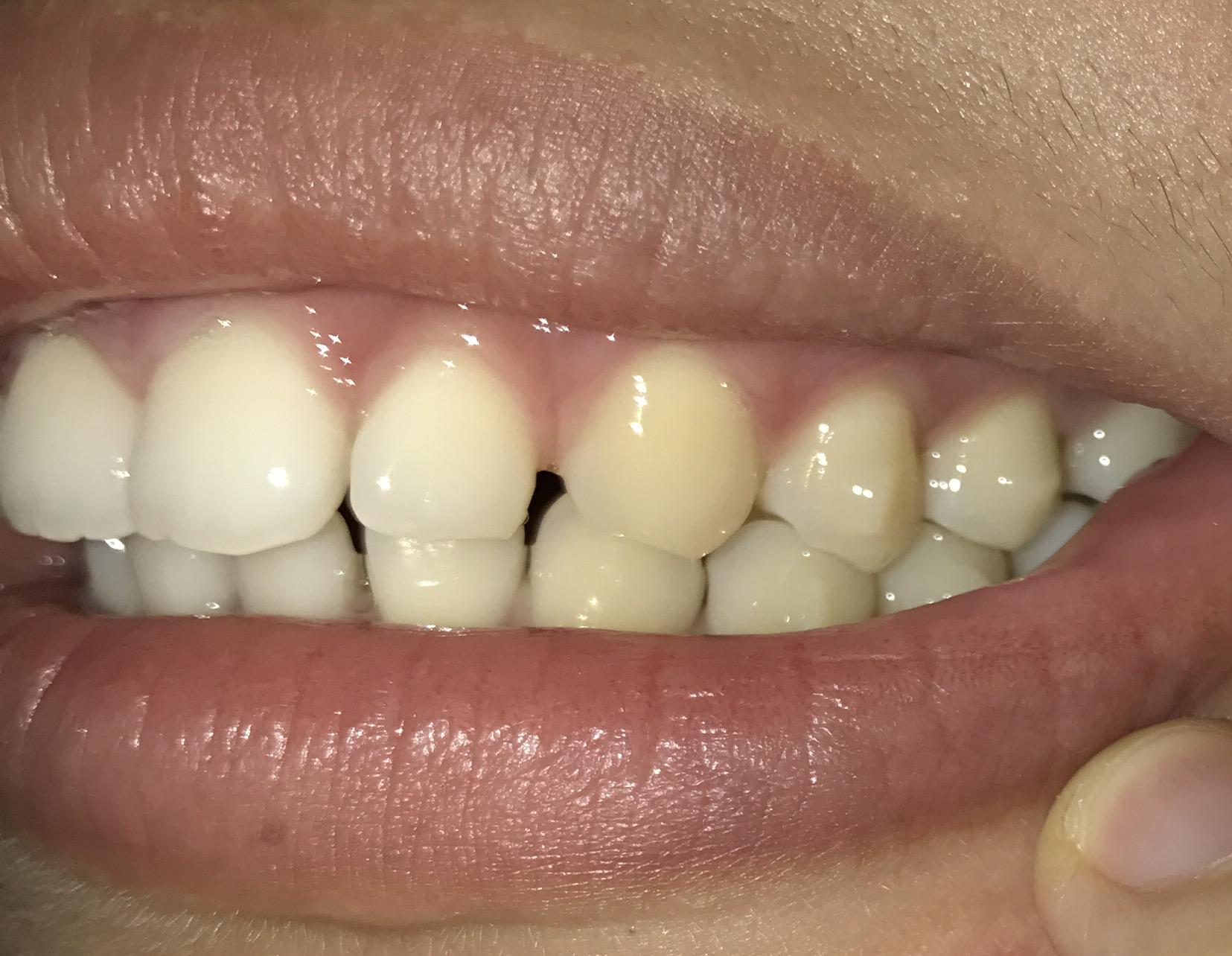 牙齿稀疏,隐形矫正? - 知乎