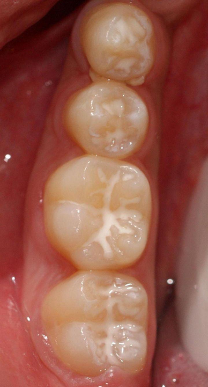 浅龋齿一定要补吗?