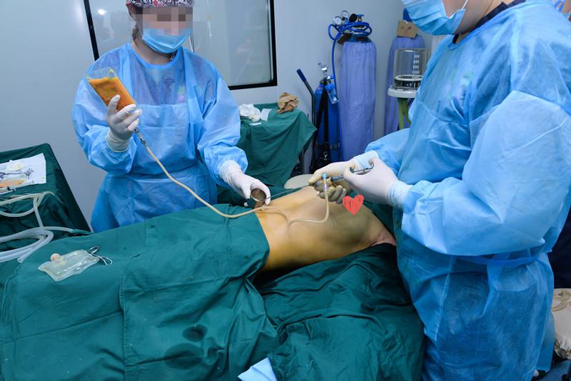 做了自体脂肪丰胸手术是怎样的体验