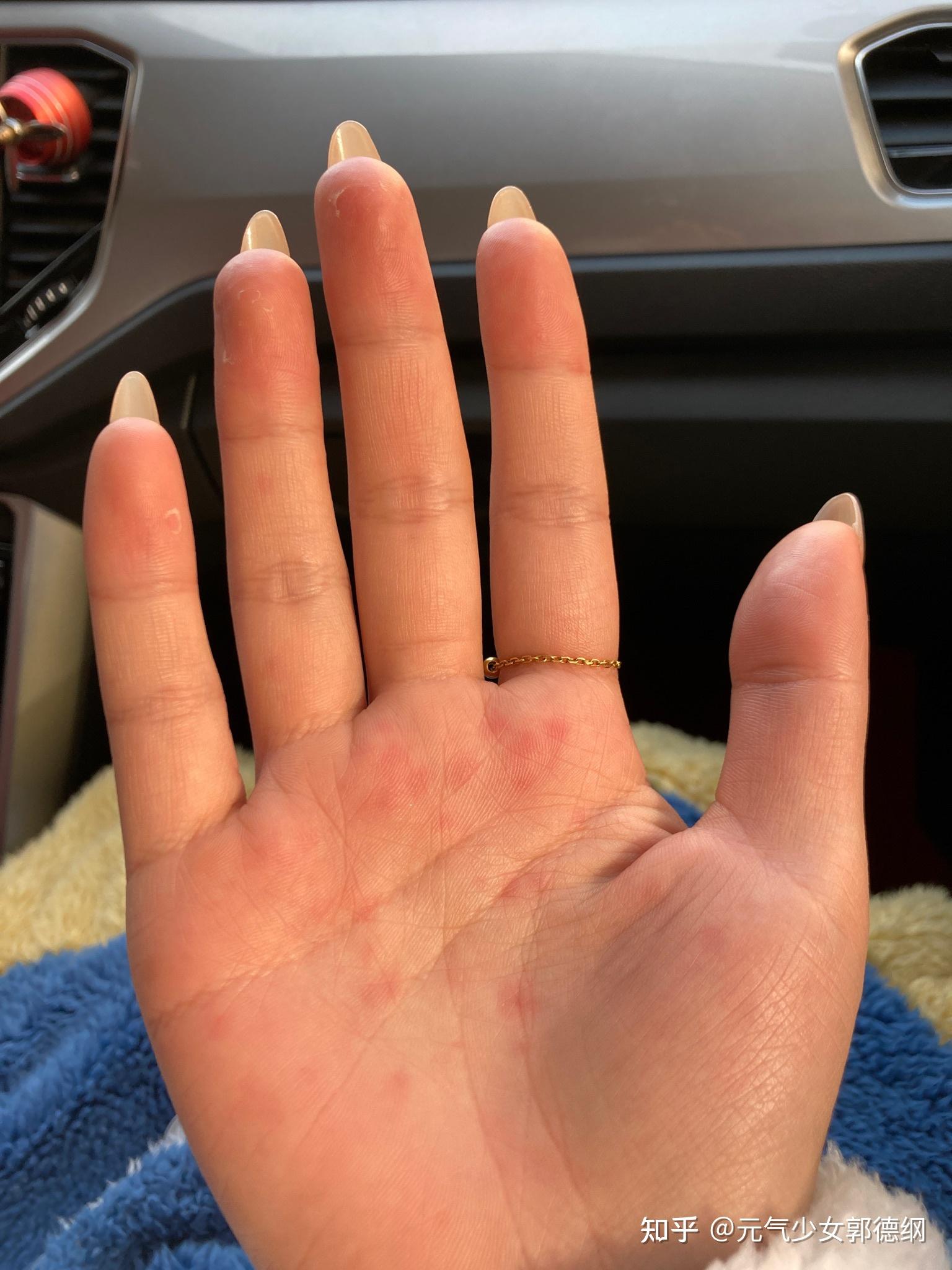 一到春秋两季,双手手心就会出现红点,很疼,略痒.