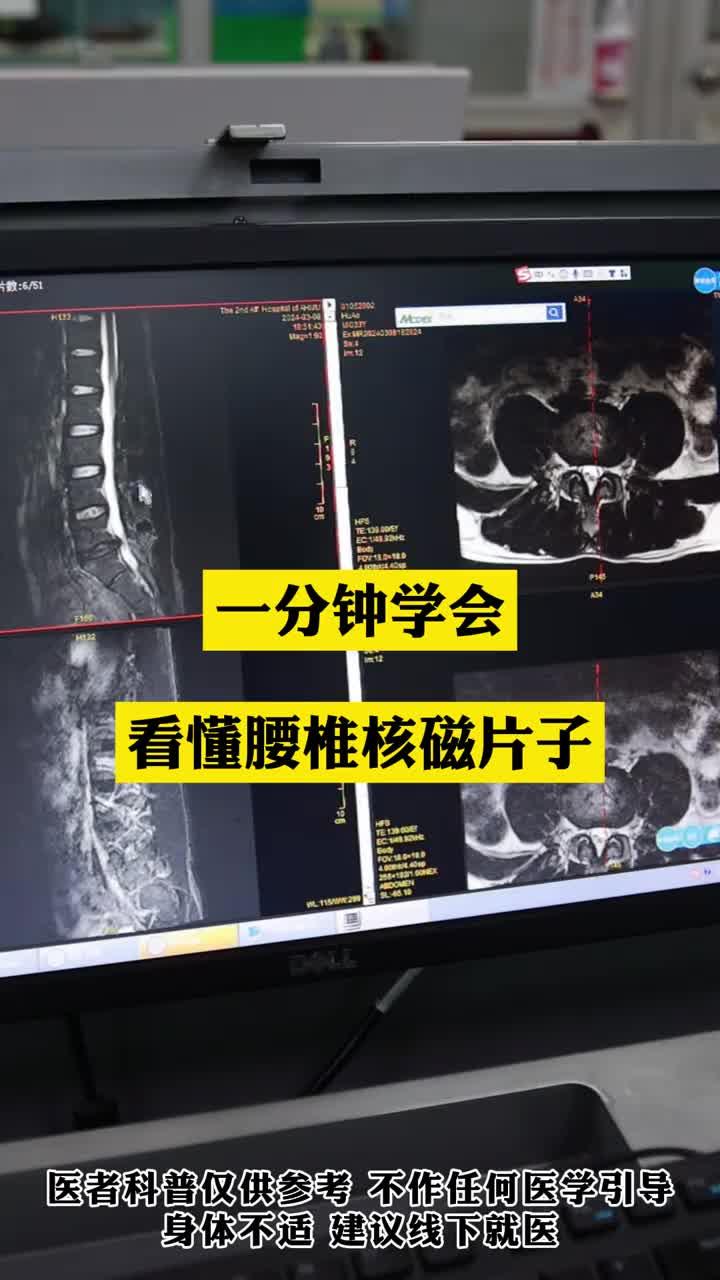 一分钟学会看懂腰椎核磁片子