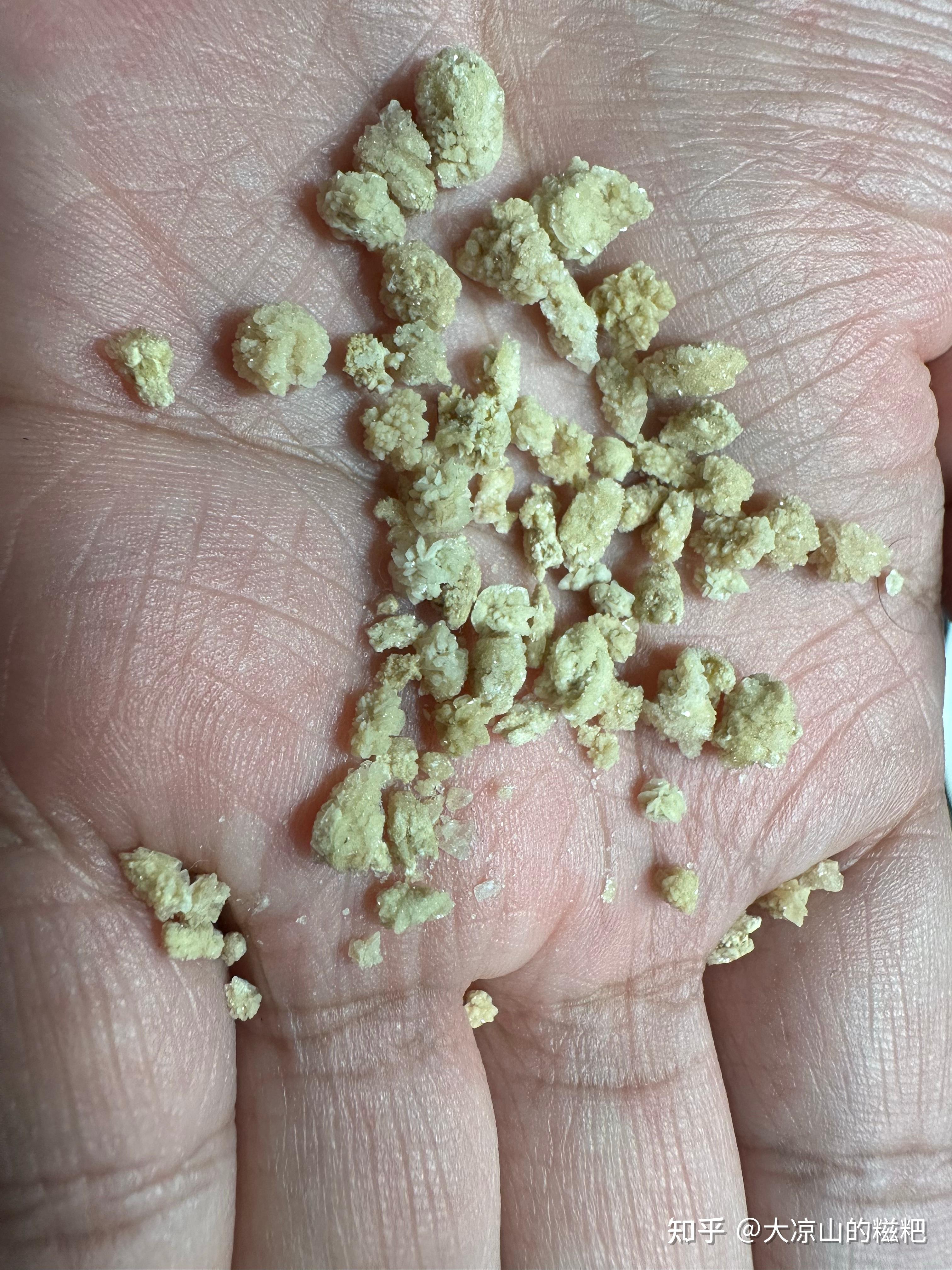 肾结石7毫米可以排出不?