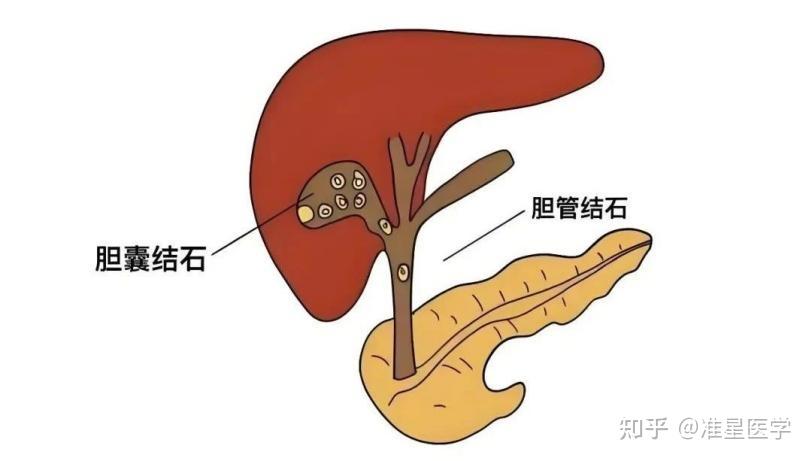 胆结石