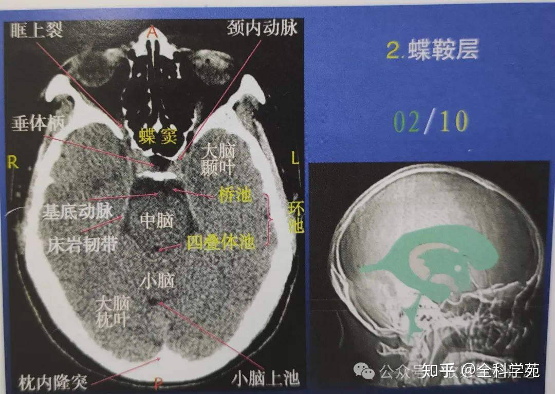 颅脑解剖、脑叶及CT表现 - 知乎