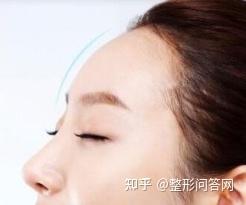 额头凹陷采用脂肪填充 自体脂肪丰额头的优势有哪些？ - 知乎