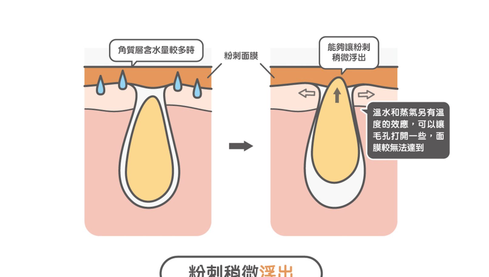 臉上閉口粉刺用什麼面膜